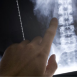 Back Injuries
