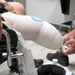 Amputation Accidents in Florida